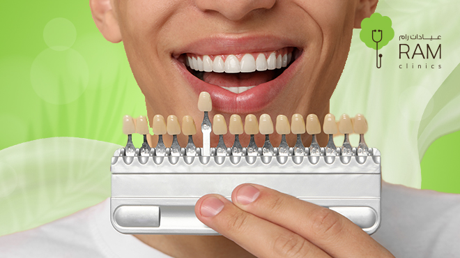 ما هو الفينير