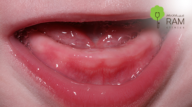 أعراض التسنين