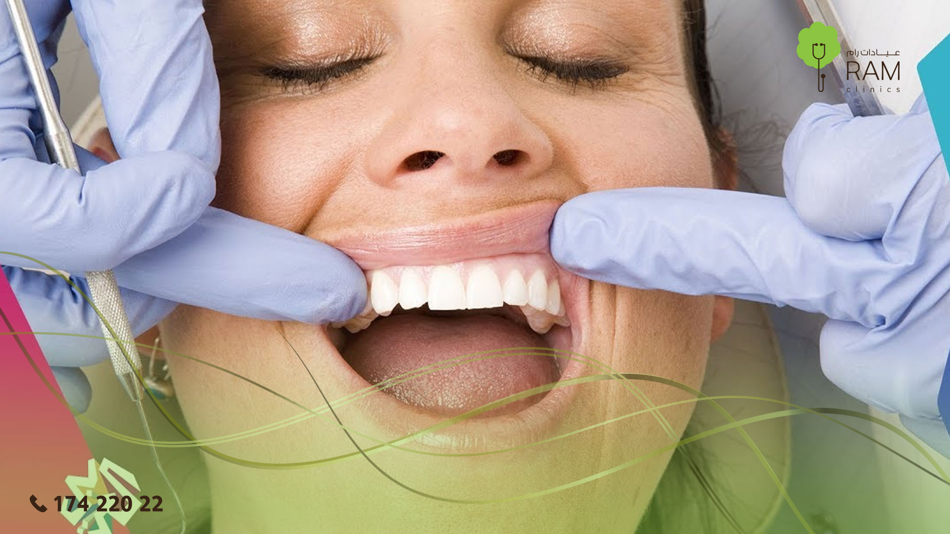 التهاب اللثة التقرحي