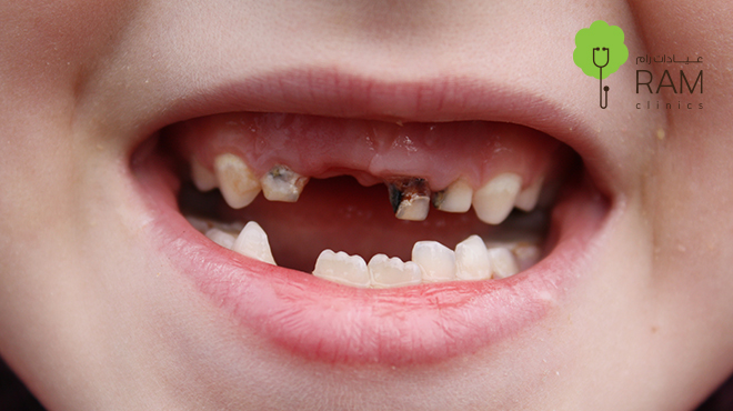 تسوس أسنان الطفل الرضيع