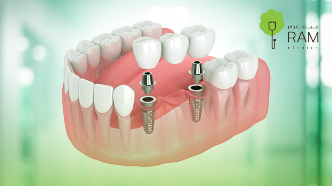 أسعار زراعة الأسنان في البحرين