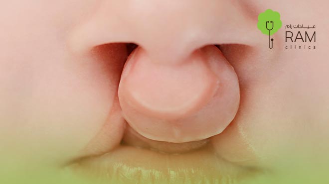 الدليل الشامل لطرق علاج الشفة الأرنبية