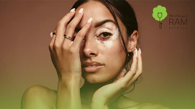 ظهور-بقع-بيضاء-في-الوجه