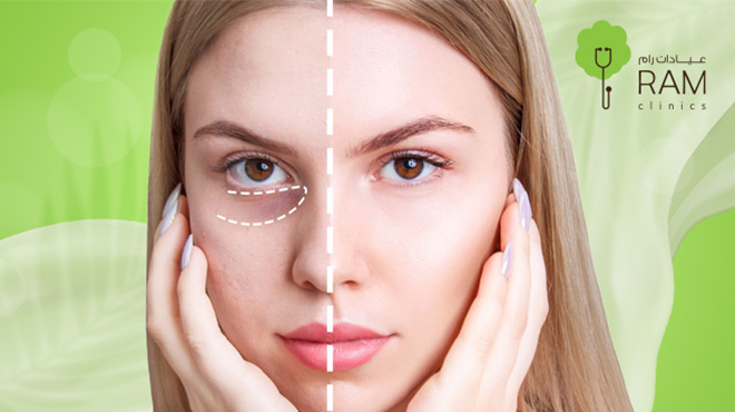 فيلر-تحت-العين