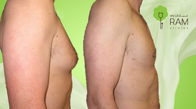 سعر-عملية-ازالة-التثدي-عند-الرجال