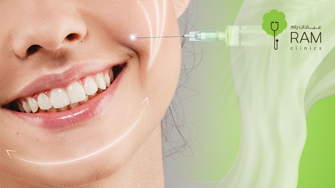 فيلر-خطوط-الابتسامة