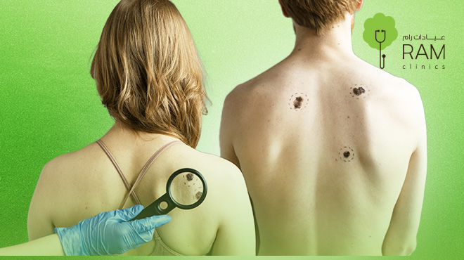 ازالة-الزوائد-الجلدية