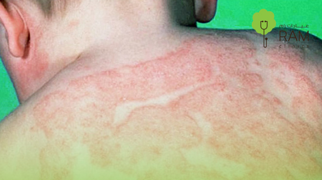 علاج-الحزام-الناري