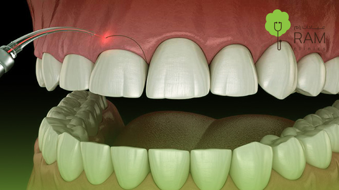 سعر-توريد-اللثة-بالليزر