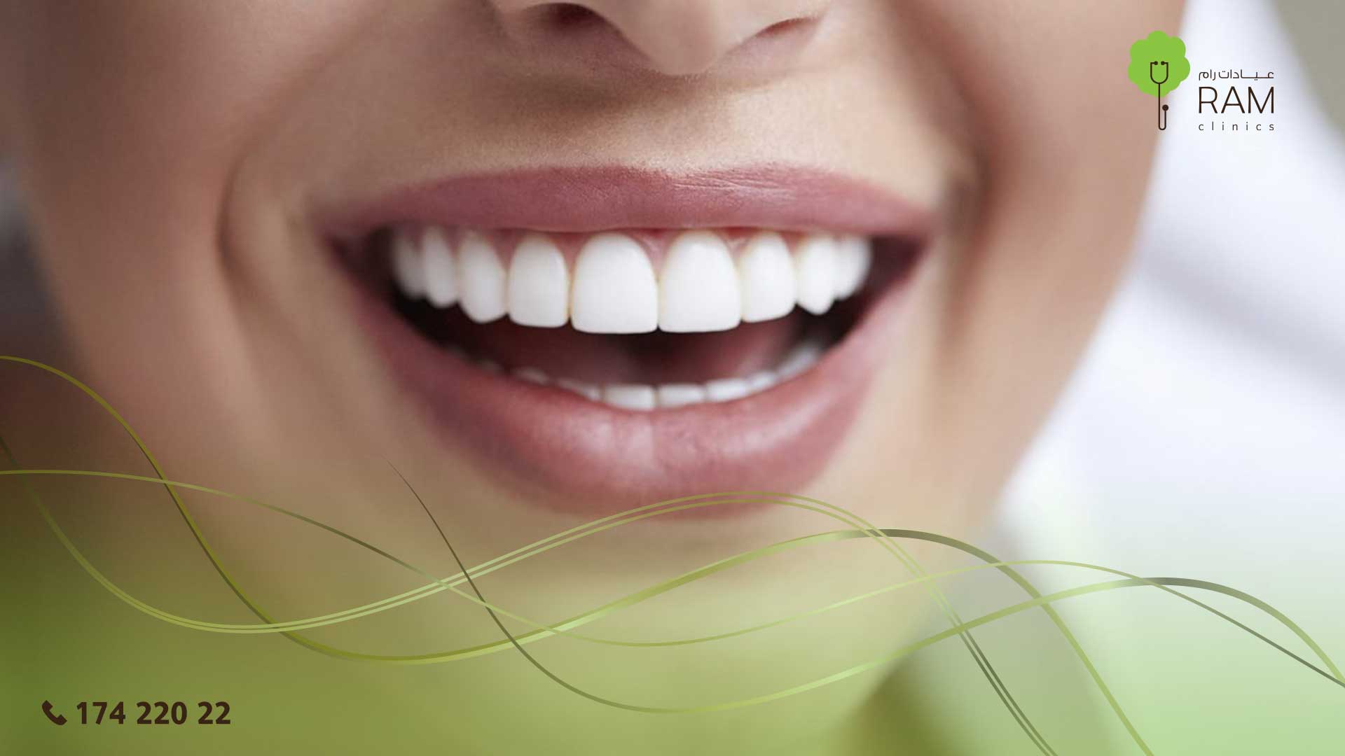 عدسات الاسنان