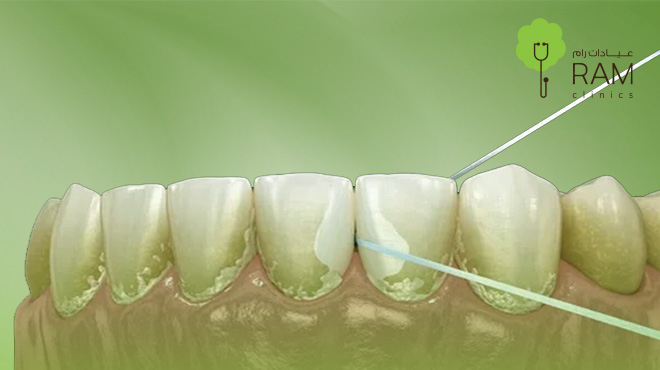 إزالة-جير-الأسنان-الأسود