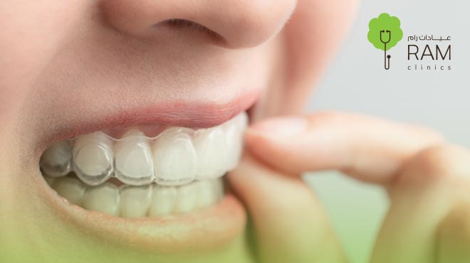  عيوب-التقويم-الشفاف