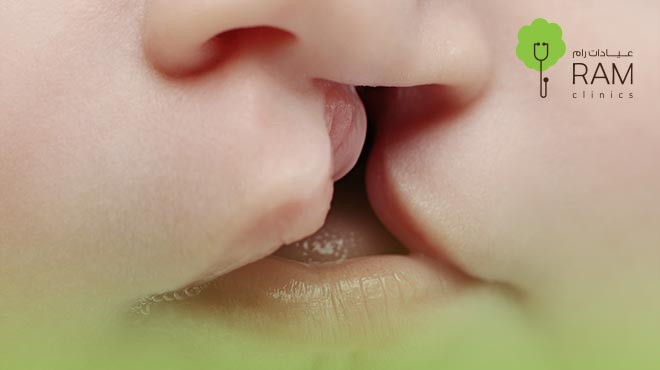 الشفة-الارنبية