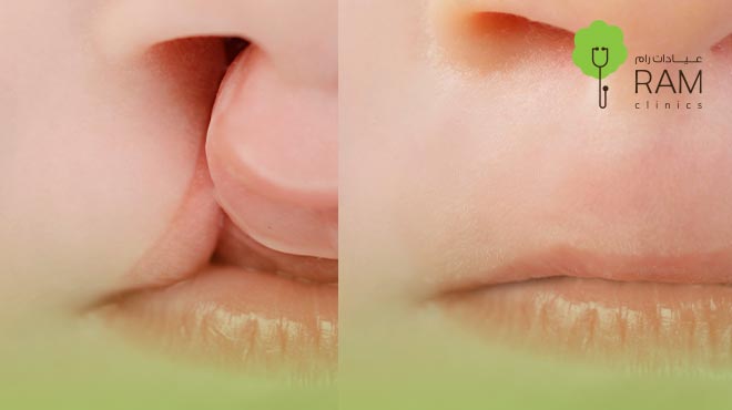 شكل-الشفه-الارنبيه-بالصور