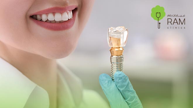 طريقة-زراعة-الأسنان