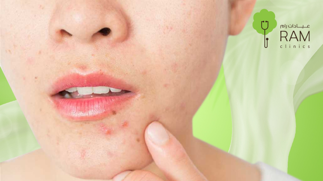 علاج-حبوب-الذقن-للنساء