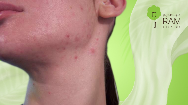 علاج-حبوب-الذقن-للنساء