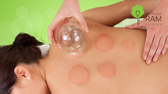 فوائد-الحجامة