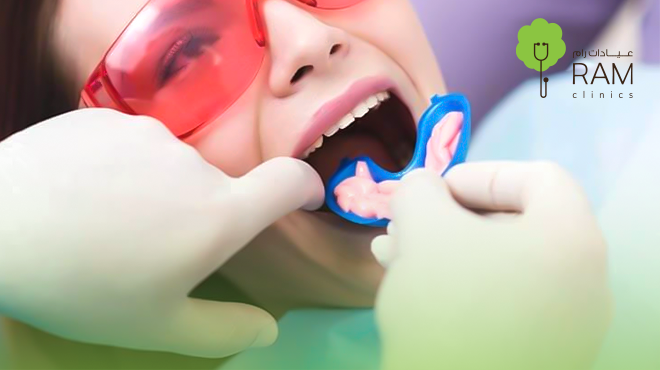 جلسة-فلورايد-للاطفال