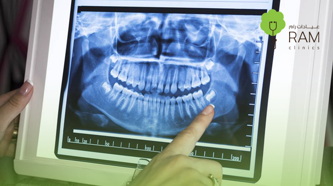 أشعة-البانورما