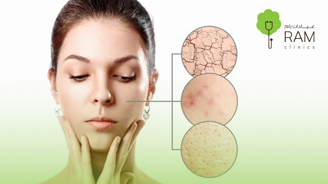 علاج-جفاف-البشرة-في-رمضان