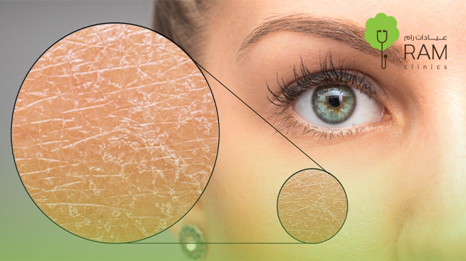 علاج-جفاف-البشرة-في-رمضان