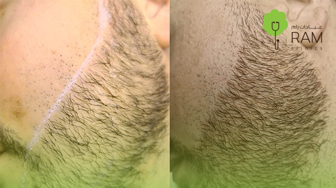 تحديد-اللحية-بالليزر