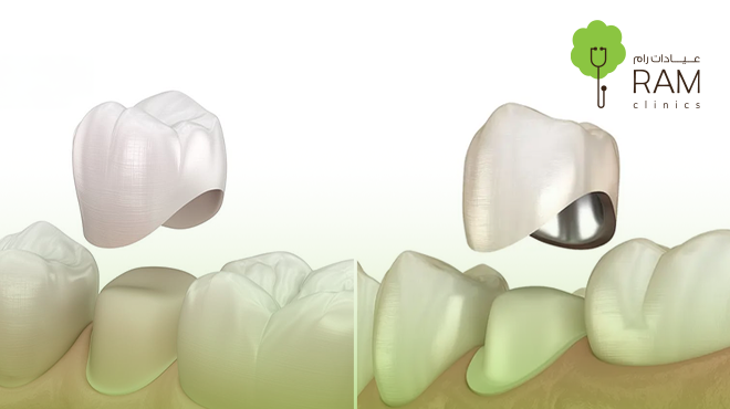 تلبيسة-الزيركون