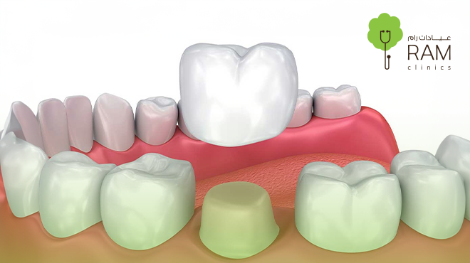 تلبيسة-الزيركون
