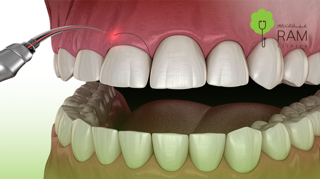 قص-اللثة-بالليزر