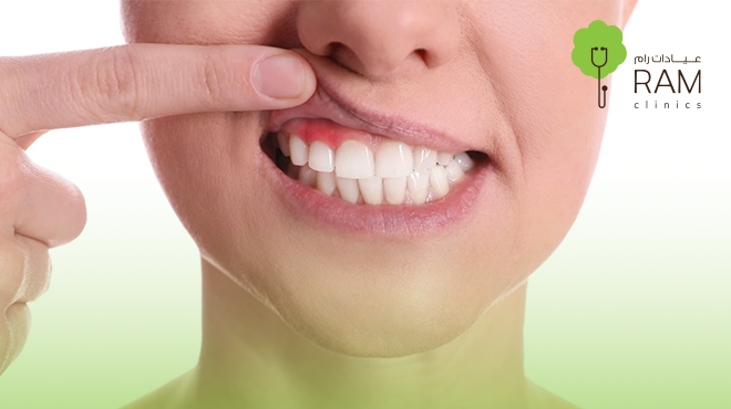 قص-اللثة-بالليزر