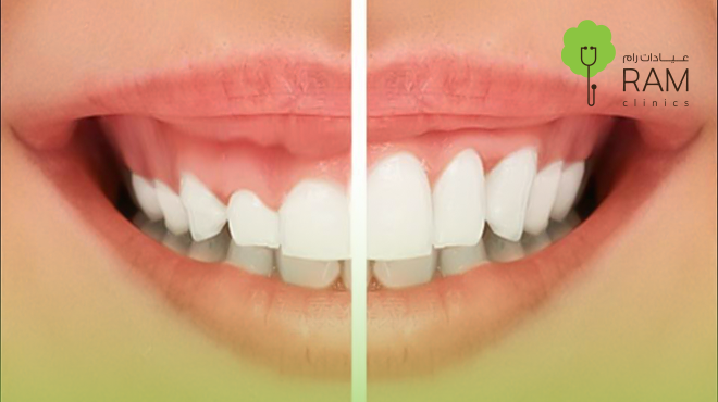 قص-اللثة-بالليزر