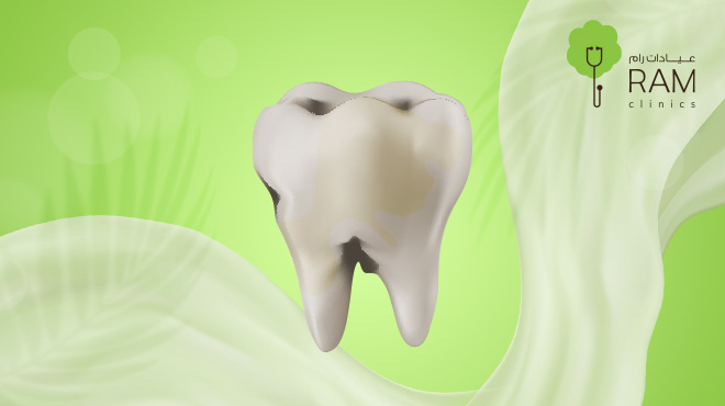 تسوس-الاسنان