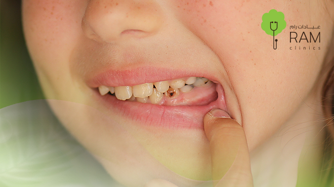 تسوس-اسنان-الاطفال