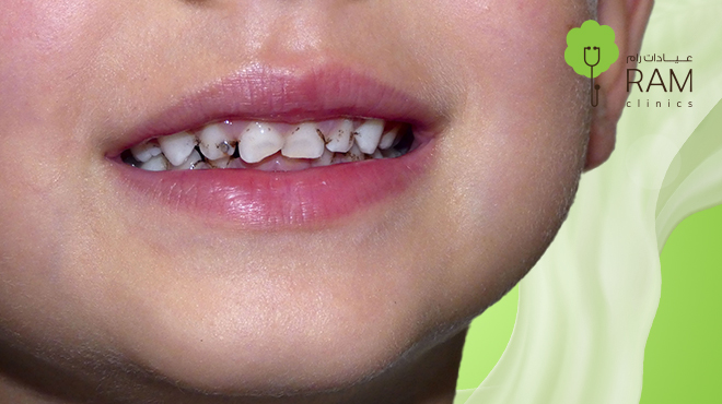 تسوس-اسنان-الاطفال