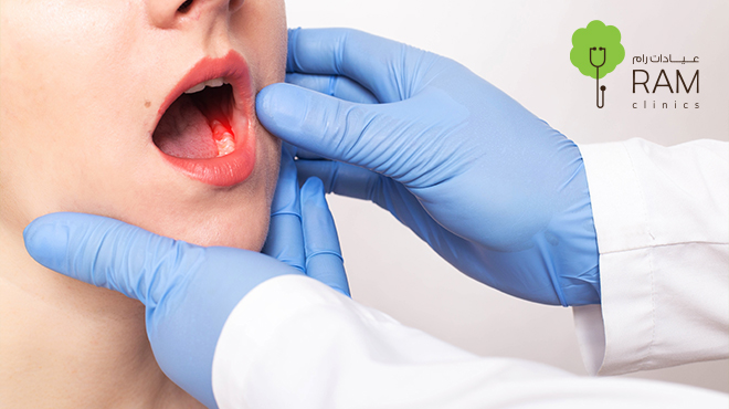 نزيف-اللثة-ليلا نزيف-اللثة-ليلا