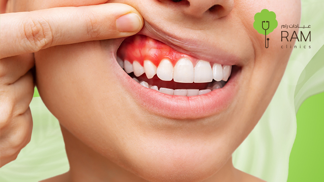 نزيف-اللثة-ليلا نزيف-اللثة-ليلا