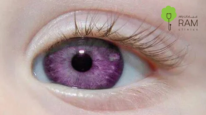 متلازمة-العيون-البنفسجية متلازمة-العيون-البنفسجية