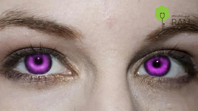 متلازمة-العيون-البنفسجية متلازمة-العيون-البنفسجية