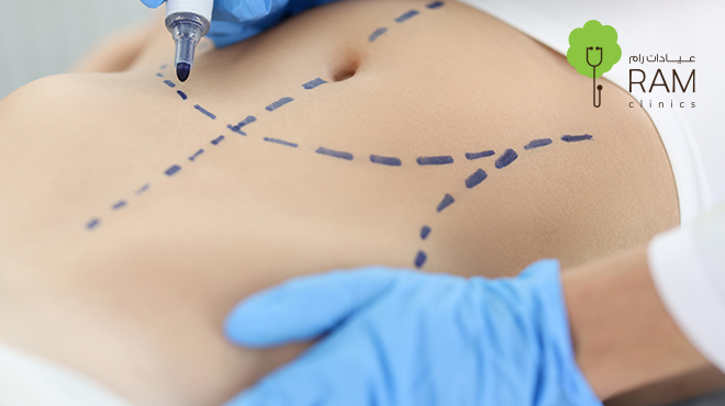 عملية-شد-البطن