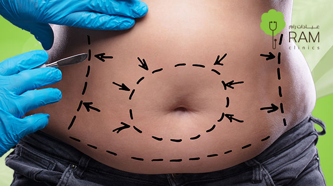 عملية-شد-البطن