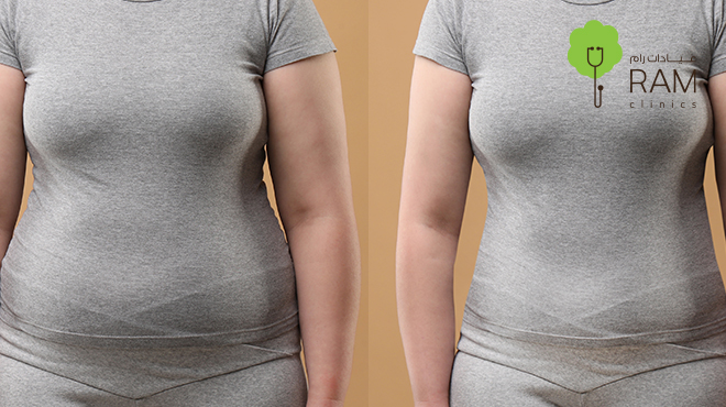 عملية-شد-البطن