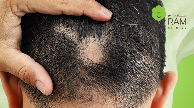 علاج-الثعلبة-عند-الرجال علاج-الثعلبة-عند-الرجال