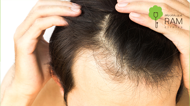 علاج-الثعلبة-عند-الرجال علاج-الثعلبة-عند-الرجال