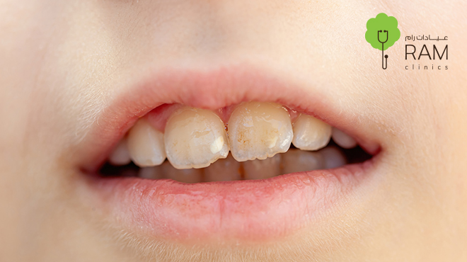 تآكل-الأسنان-عند-الأطفال