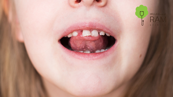 تآكل-الأسنان-عند-الأطفال