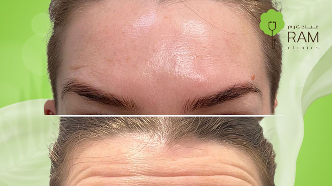 البوتكس-للوجه البوتكس-للوجه