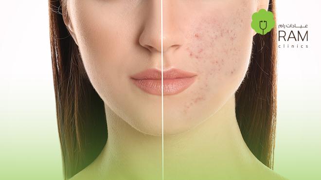 جلسة-هيدرافيشل جلسة-هيدرافيشل