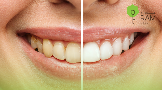 تنظيف-وتبييض-الأسنان تنظيف-وتبييض-الأسنان