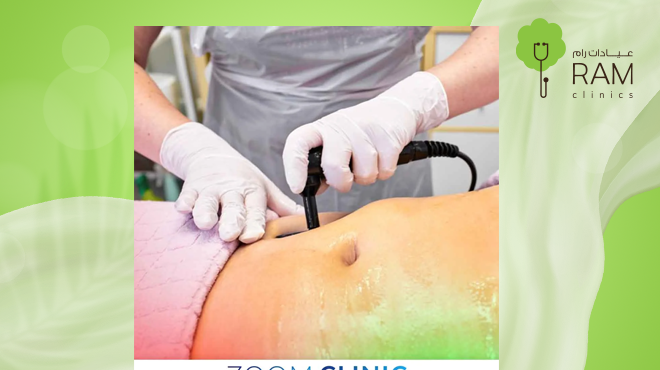 شفط-الدهون-بالفيزر